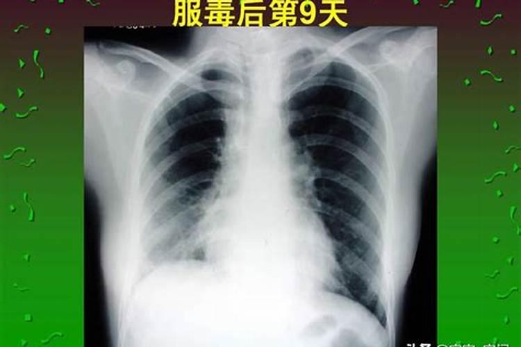 百草枯的中毒症状