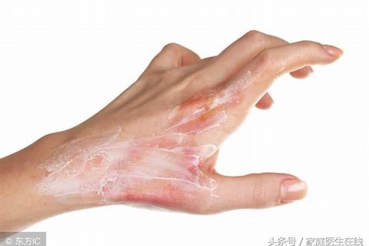 开水烫伤脱皮